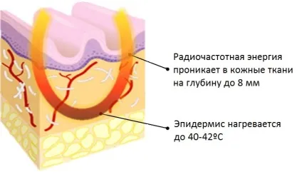Rf-ліфтинг живота ефективна корекція без хірургії (rf-ліфтинг) Rf-ліфтинг живота ефективна корекція без хірургії