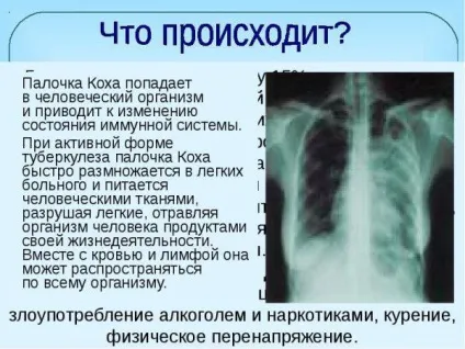 Режими хіміотерапії при туберкульозі легенів стадії, фази, наслідки (фази) Режими хіміотерапії при туберкульозі легенів стадії, фази, наслідки