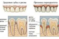 Шишка на яснах