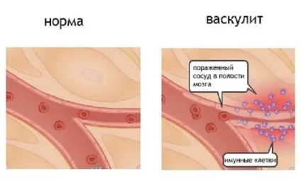 Системний васкуліт що це таке, симптоми, лікування, класифікація