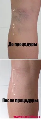 Склеротерапія вен і судин, ціна, відгуки та наслідки (судин) Склеротерапія вен і судин, ціна, відгуки та наслідки