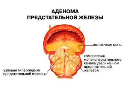 Трави для лікування простатиту і аденоми народні рецепти (рецепти) Трави для лікування простатиту і аденоми народні рецепти