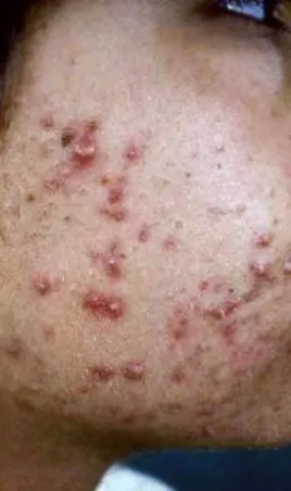 Вугрі причини, симптоми, лікування (лікування вугрового висипу) Вугрі причини, симптоми, лікування