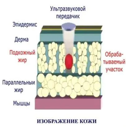 Ультразвукова кавітація - що це таке, вартість і відгуки (ультразвукова) Ультразвукова кавітація - що це таке, вартість і відгуки