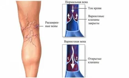 Ультразвукова доплерографія судин нижніх кінцівок (вен, артерій) (ультразвукова) Ультразвукова доплерографія судин нижніх кінцівок (вен, артерій)