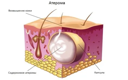 Видалення атероми або консервативне лікування - причини, симптоми і лікування кісти сальної залози (видалення атероми) Видалення атероми або консервативне лікування - причини, симптоми і лікування кісти сальної залози