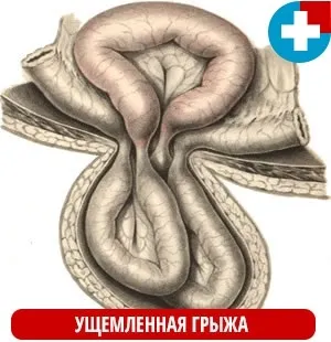 Вражена пахова грижа у дорослого (грижа) Вражена пахова грижа у дорослого