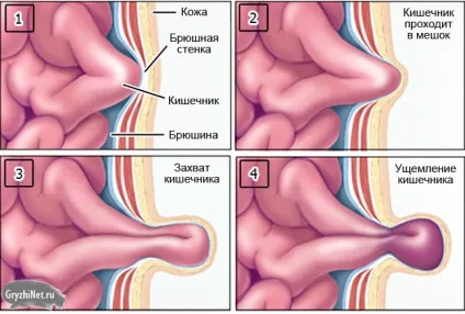 Вражена пахова грижа причини, симптоми і лікування (фото) (защемлена) Вражена пахова грижа причини, симптоми і лікування (фото)