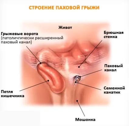 Обмеження (защемлення) пахової грижі ознаки, симптоми, ускладнення (грижі) Обмеження (защемлення) пахової грижі ознаки, симптоми, ускладнення