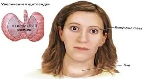 Збільшення щитовидної залози симптоми, лікування і що робити, якщо щитовидка збільшилася (симптоми) Збільшення щитовидної залози симптоми, лікування і що робити, якщо щитовидка збільшилася
