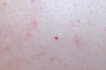 Вузлики на шкірі
