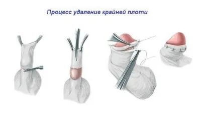 Вуздечка на голівці у чоловіків навіщо потрібна, де знаходиться, як виглядає (уникнути проблем вуздечкою) Вуздечка на голівці у чоловіків навіщо потрібна, де знаходиться, як виглядає