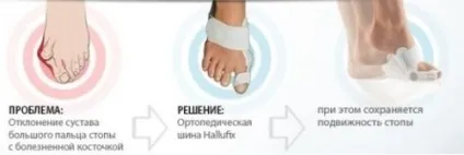 Вальгусна шина огляд бандажів і фіксаторів, відгуки (відгуки) Вальгусна шина огляд бандажів і фіксаторів, відгуки
