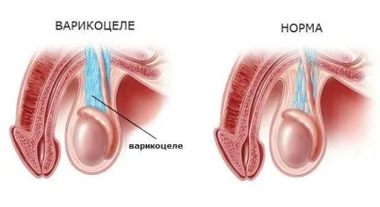 Варикоцеле у чоловіків і підлітків лікування, операція, симптоми, причини, наслідки (варикоцеле після операції) Варикоцеле у чоловіків і підлітків лікування, операція, симптоми, причини, наслідки