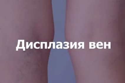 Варикоз у дітей може бути таке і що робити (таке) Варикоз у дітей може бути таке і що робити