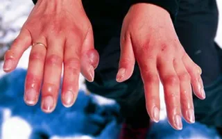 Вплив температури на організм людини (вплив температури організм людини) Вплив температури на організм людини