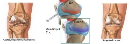 Внутрісуглобні ін'єкції в колінний суглоб, введення гіалуронової кислоти (колінний) Внутрісуглобні ін'єкції в колінний суглоб, введення гіалуронової кислоти