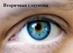 Вторинна глаукома причини, види, стімптоми і методи лікування (вторинна) Вторинна глаукома причини, види, стімптоми і методи лікування
