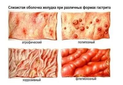 У животі різі причини патології та специфіка лікування (причини) У животі різі причини патології та специфіка лікування