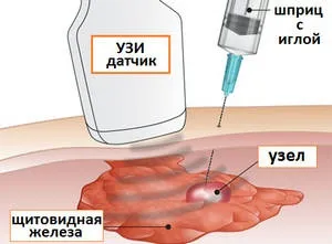 Холодний і гарячий вузол щитовидної залози що це таке симптоми, лікування (холодний) Холодний і гарячий вузол щитовидної залози що це таке симптоми, лікування