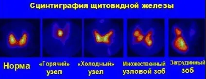 Холодний вузол щитовидної залози (щитовидної) Холодний вузол щитовидної залози