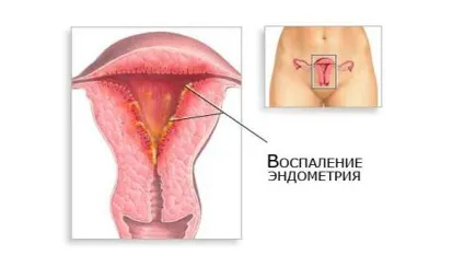 Хронічний ендометрит чи можна його вилікувати, завагітніти і виносити дитину (хронічний) Хронічний ендометрит чи можна його вилікувати, завагітніти і виносити дитину