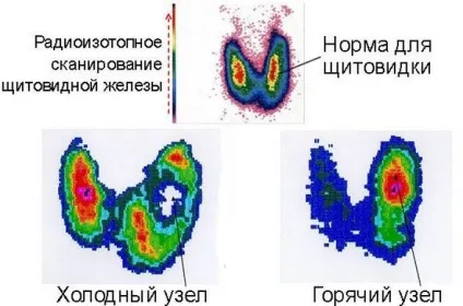 Холодний і гарячий вузол щитовидної залози що це таке симптоми, лікування (залози) Холодний і гарячий вузол щитовидної залози що це таке симптоми, лікування