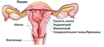 Залозистий поліп ендометрія лікування після видалення (лікування) Залозистий поліп ендометрія лікування після видалення