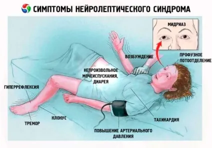 Злоякісний нейролептичний синдром що це таке (таке) Злоякісний нейролептичний синдром що це таке