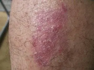 Сверблячка гомілок причини і лікування (лікування) Сверблячка гомілок причини і лікування