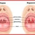 Бета-гемолітичний стрептокок симптоми і лікування (симптоми) Бета-гемолітичний стрептокок симптоми і лікування