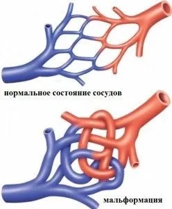 Артеріовенозна мальформация судин головного мозку - симтомов і лікування