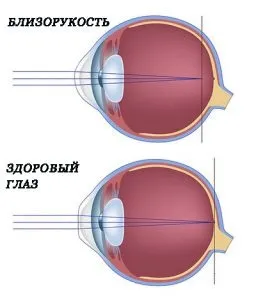 Короткозорість у дітей шкільного віку