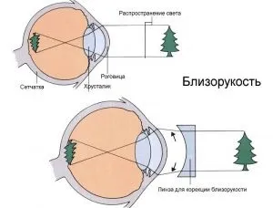Короткозорість у дітей шкільного віку