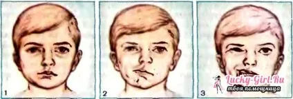 Блукаючий нерв - симптоми і лікування (блукаючий) Блукаючий нерв - симптоми і лікування