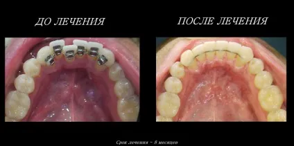 Брекети фото до і після установки конструкції (після) Брекети фото до і після установки конструкції