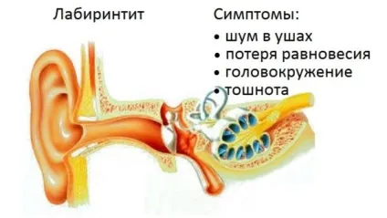 Чим небезпечний фарингіт ускладнення і наслідки захворювання (захворювання) Чим небезпечний фарингіт ускладнення і наслідки захворювання