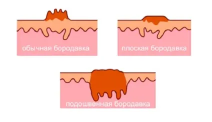 Бородавки що таке, як виглядає, будова, корінь, заразні чи (будова бородавки) Бородавки що таке, як виглядає, будова, корінь, заразні чи