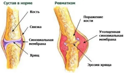 Чим небезпечний фарингіт ускладнення і наслідки захворювання (наслідки) Чим небезпечний фарингіт ускладнення і наслідки захворювання