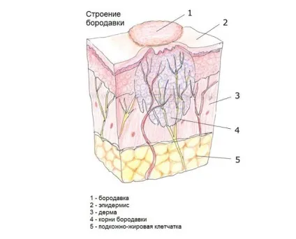 Бородавки що таке, як виглядає, будова, корінь, заразні чи (виглядає) Бородавки що таке, як виглядає, будова, корінь, заразні чи