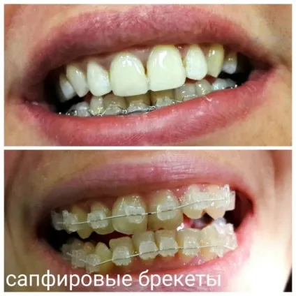 Брекети фото до і після установки конструкції (установки) Брекети фото до і після установки конструкції