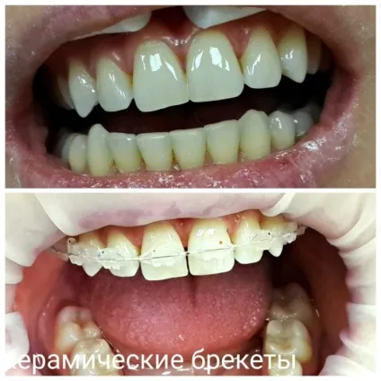 Брекети фото до і після установки конструкції (фото) Брекети фото до і після установки конструкції