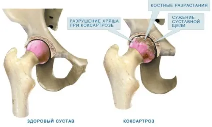 Деформуючий остеоартроз кульшового суглоба (доа) 1, 2, 3 ступеня причини, симптоми, лікування (остеоартроз) Деформуючий остеоартроз кульшового суглоба (доа) 1, 2, 3 ступеня причини, симптоми, лікування
