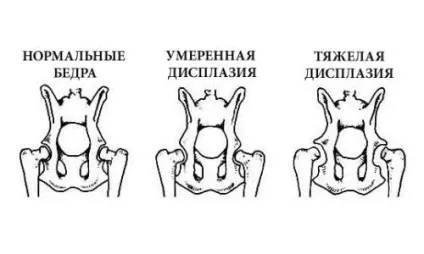 Деформуючий остеоартроз кульшового суглоба (доа) 1, 2, 3 ступеня причини, симптоми, лікування (суглоба) Деформуючий остеоартроз кульшового суглоба (доа) 1, 2, 3 ступеня причини, симптоми, лікування