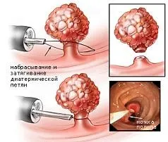Ендоскопічна поліпектомія (поліпектомія ендоскопічна, видалення поліпа кишечника) (поліпа) Ендоскопічна поліпектомія (поліпектомія ендоскопічна, видалення поліпа кишечника)