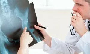 Доа тазостегнового суглоба 2 ступеня лікування і профілактика (профілактика) Доа тазостегнового суглоба 2 ступеня лікування і профілактика