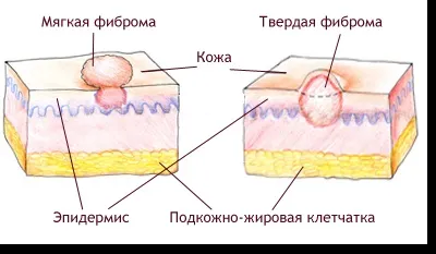 Фіброма шкіри лікування м'якої та твердої фіброми