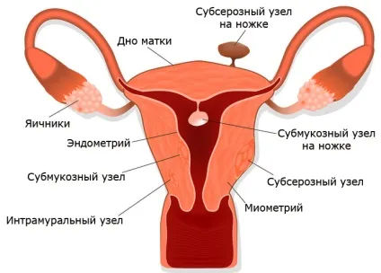Фіброматозних вузол в матці причини і лікування (вузол) Фіброматозних вузол в матці причини і лікування