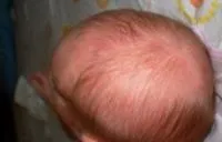 Гнойнички у новонароджених