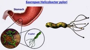 Гастрит, дуоденіт